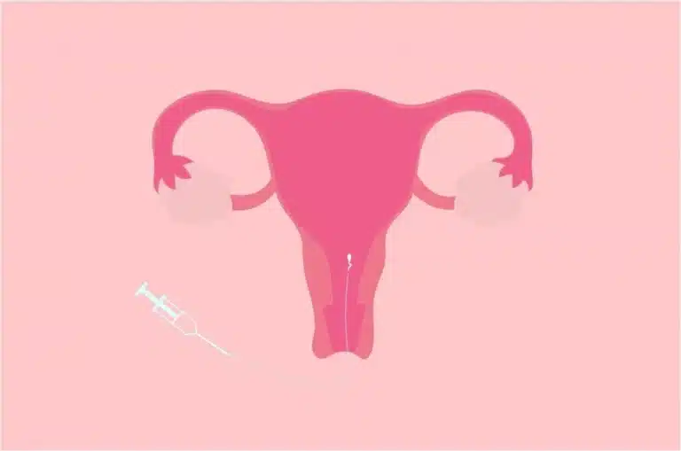 Illustration vectorielle insémination intra utérine
